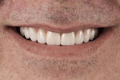 Prep-less Veneers Before & After Gallery - Patient 302264 - Image 2