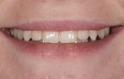 Prep-less Veneers Before & After Gallery - Patient 327568 - Image 1