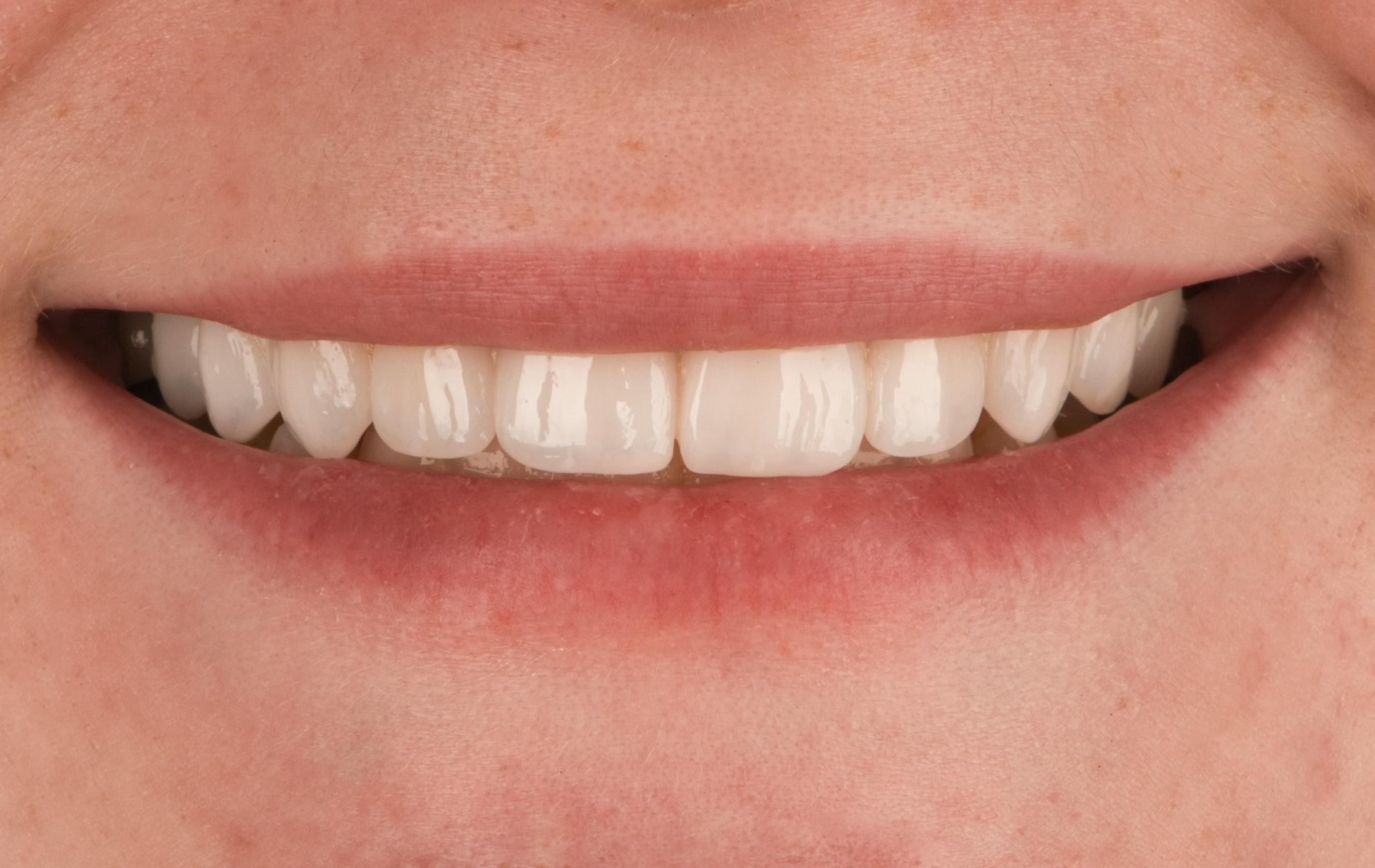 procedure after