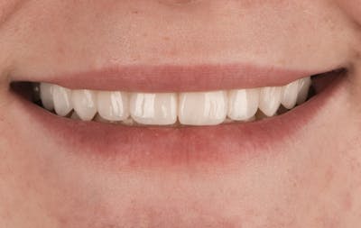 Prep-less Veneers Before & After Gallery - Patient 327568 - Image 2