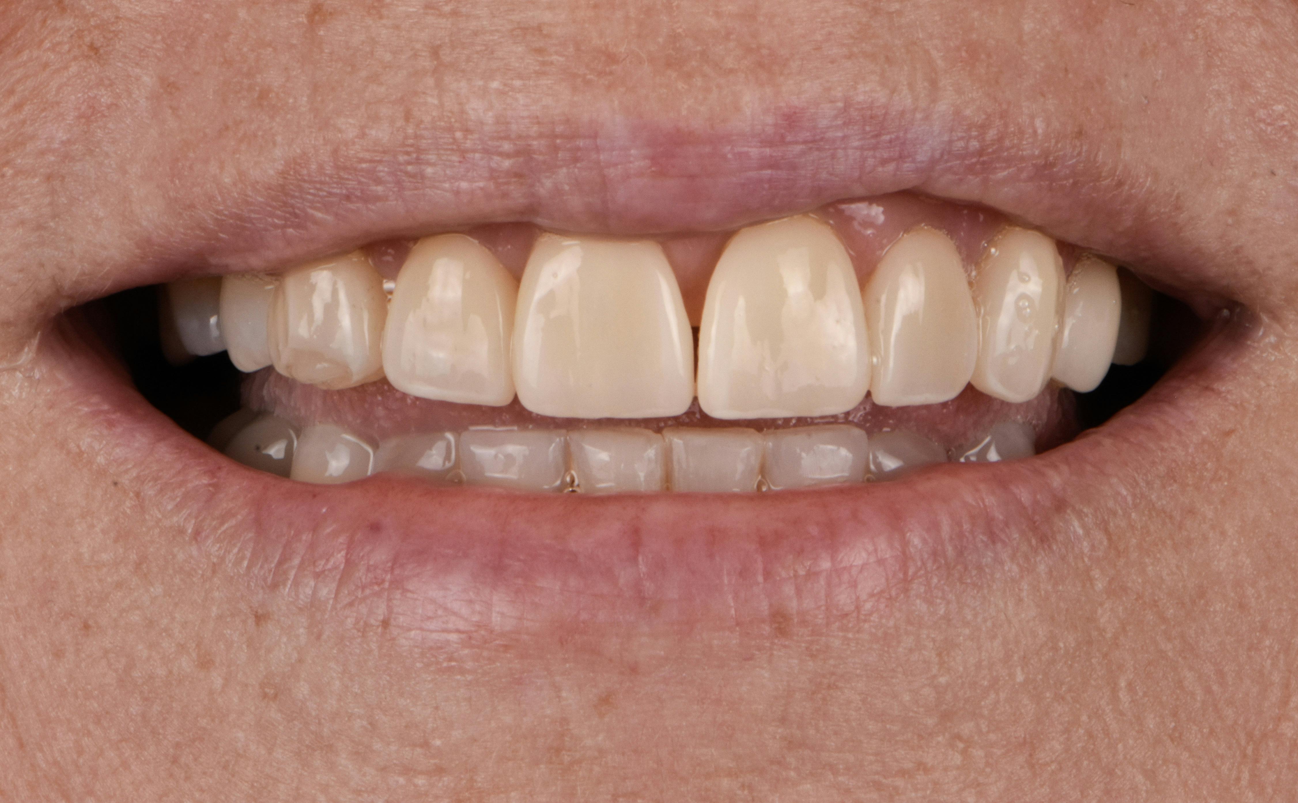 Before & After Photos | Charleston Center for Cosmetic and Restorative Dentistry - Porcelain Veneers - Patient 4 - Before Procedure