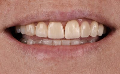 Porcelain Veneers Before & After Gallery - Patient 272317 - Image 1