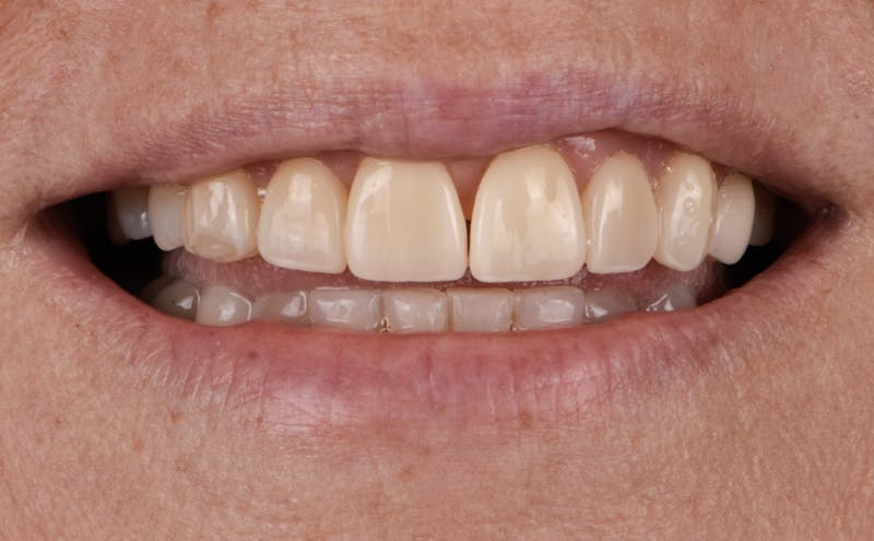 Porcelain Veneers Before & After Gallery - Patient 272317 - Image 1