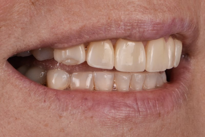 Porcelain Veneers Before & After Gallery - Patient 272317 - Image 3