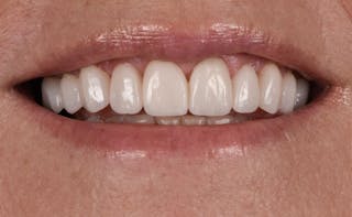Porcelain Veneers Before & After Gallery - Patient 272317 - Image 2