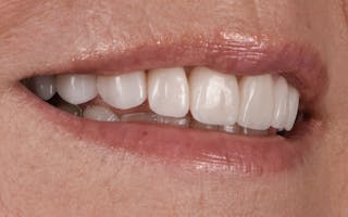 Porcelain Veneers Before & After Gallery - Patient 272317 - Image 4
