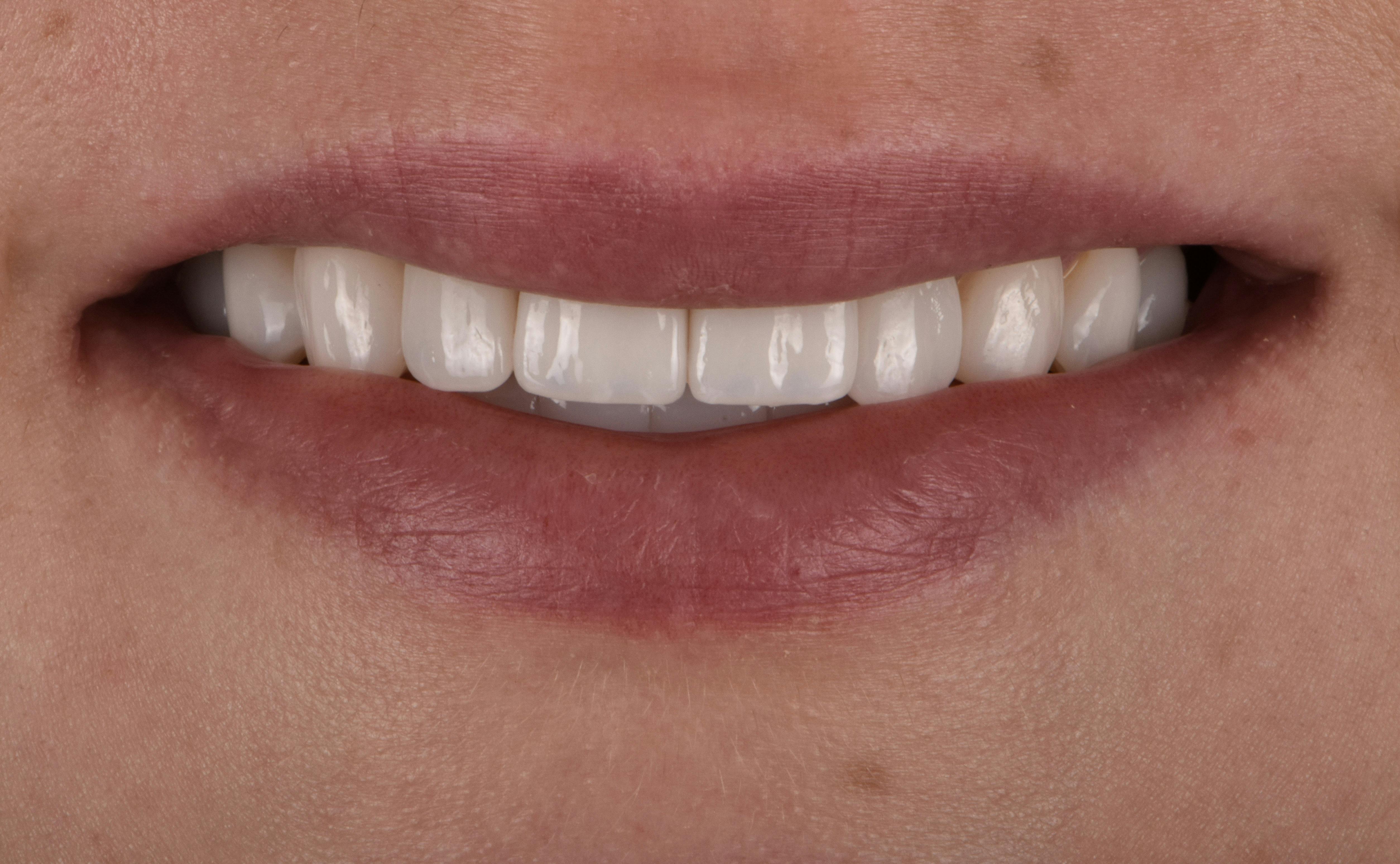 Before & After Photos | Charleston Center for Cosmetic and Restorative Dentistry - Porcelain Veneers - Patient 3 - After Procedure