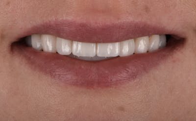 Porcelain Veneers Before & After Gallery - Patient 351300 - Image 2
