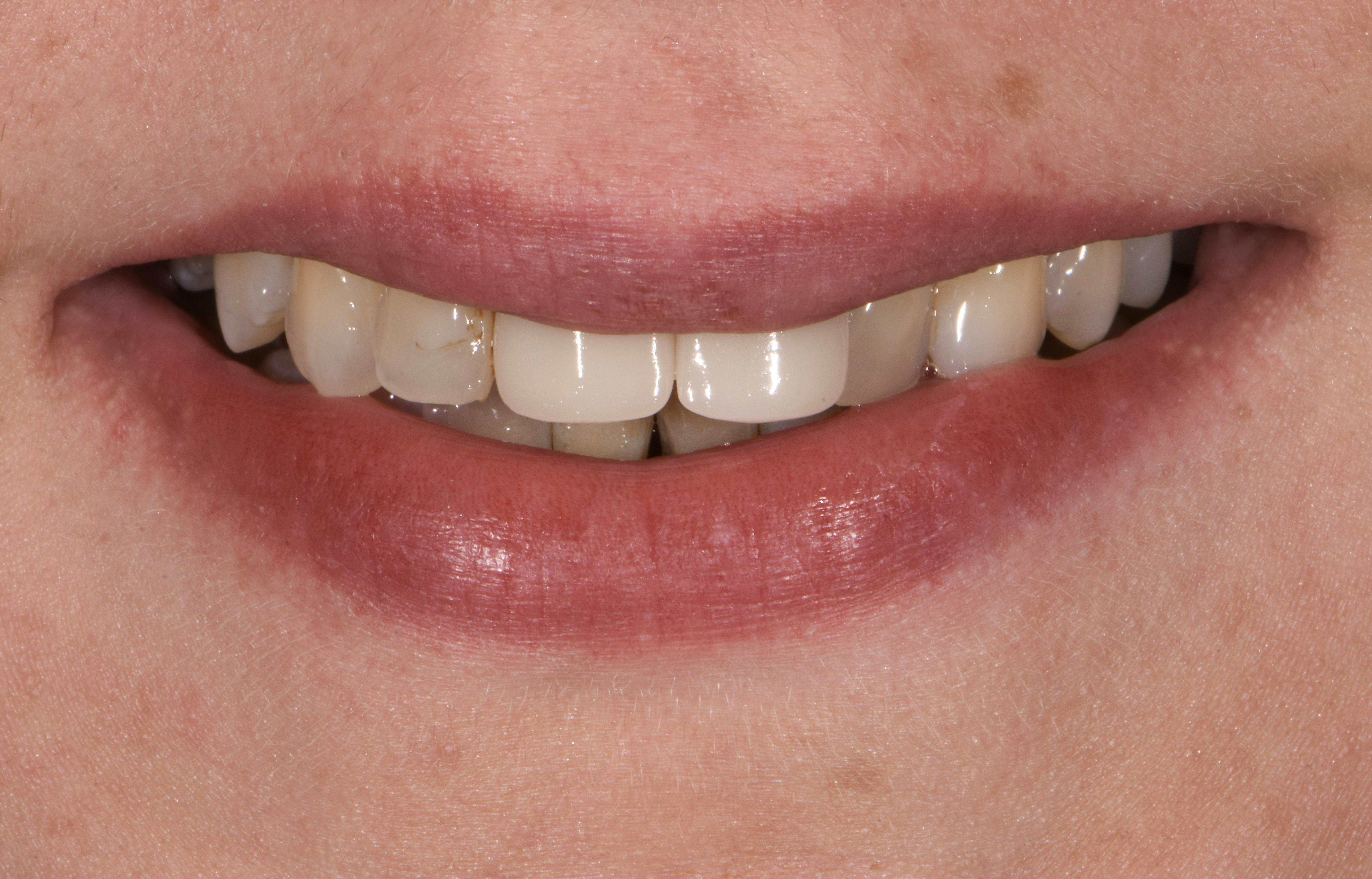 Before & After Photos | Charleston Center for Cosmetic and Restorative Dentistry - Porcelain Veneers - Patient 3 - Before Procedure