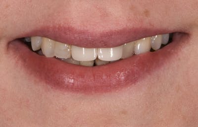 Porcelain Veneers Before & After Gallery - Patient 351300 - Image 1