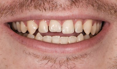 Porcelain Veneers Before & After Gallery - Patient 390194 - Image 1