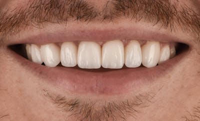 Porcelain Veneers Before & After Gallery - Patient 390194 - Image 2