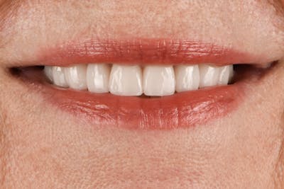 Prep-less Veneers Before & After Gallery - Patient 332019 - Image 2