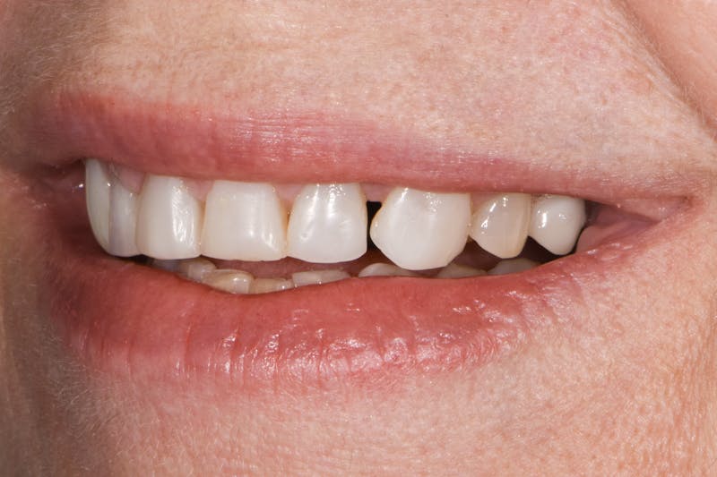 Prep-less Veneers Before & After Gallery - Patient 332019 - Image 3