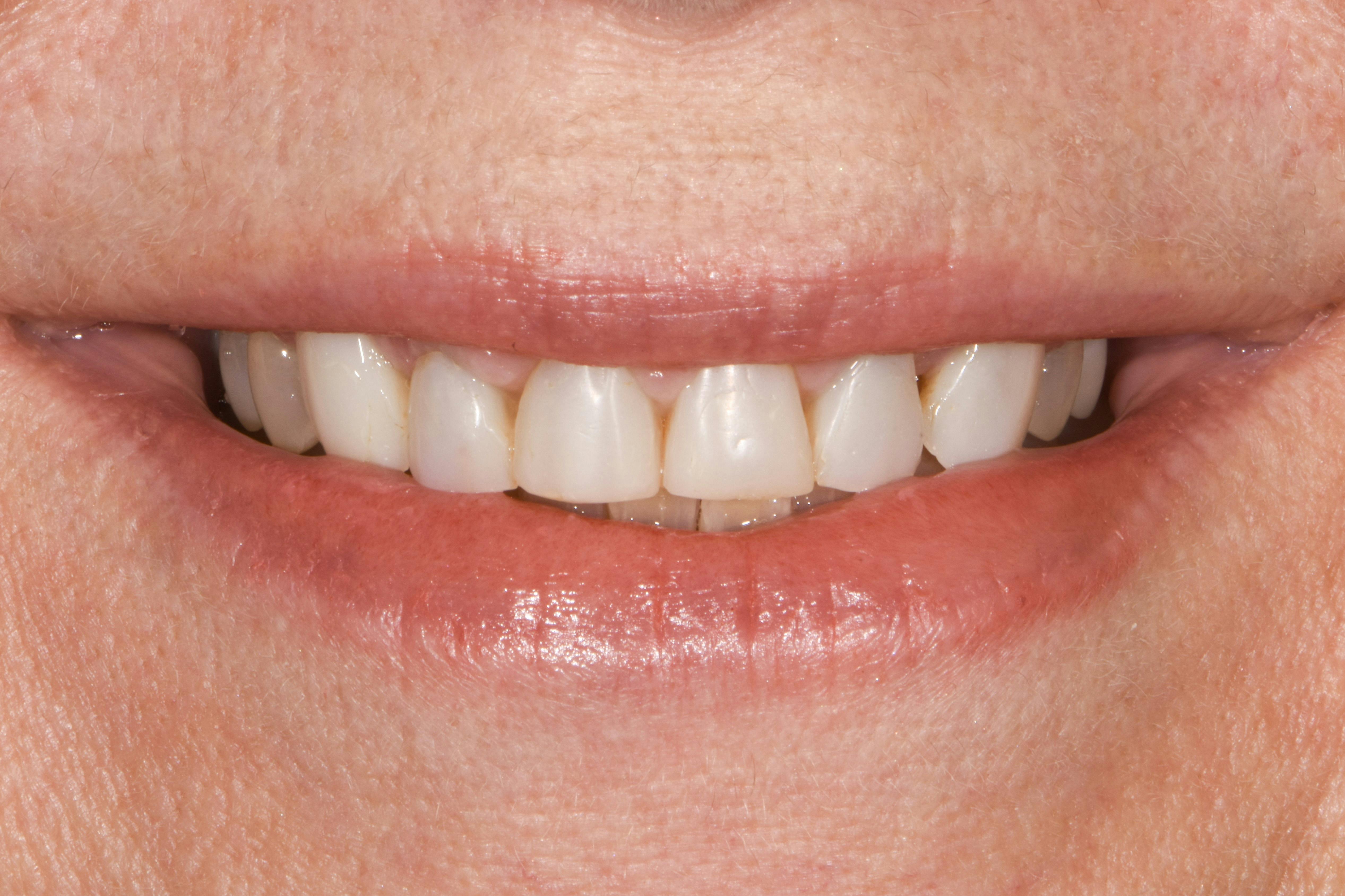 Before & After Photos | Charleston Center for Cosmetic and Restorative Dentistry - Prep-less Veneers - Patient 3 - Before Procedure