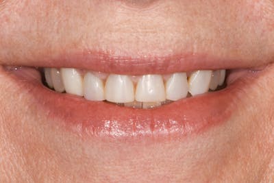 Prep-less Veneers Before & After Gallery - Patient 332019 - Image 1