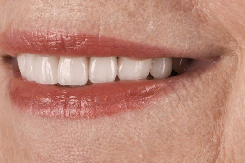 Prep-less Veneers Before & After Gallery - Patient 332019 - Image 4
