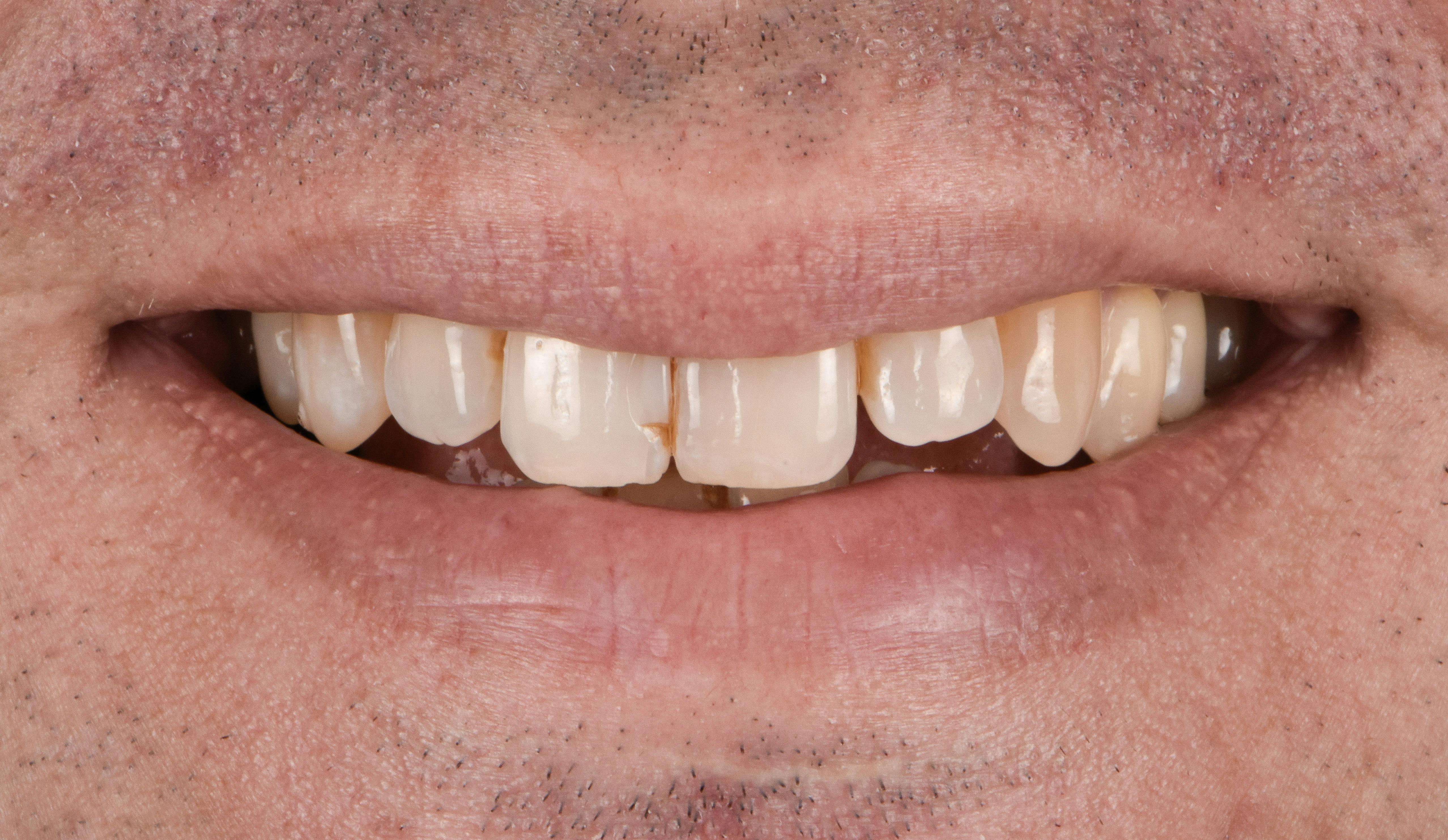 Before & After Photos | Charleston Center for Cosmetic and Restorative Dentistry - Porcelain Veneers - Patient 1 - Before Procedure