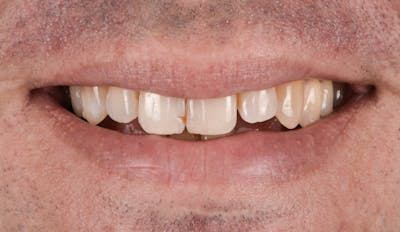 Porcelain Veneers Before & After Gallery - Patient 231504 - Image 1
