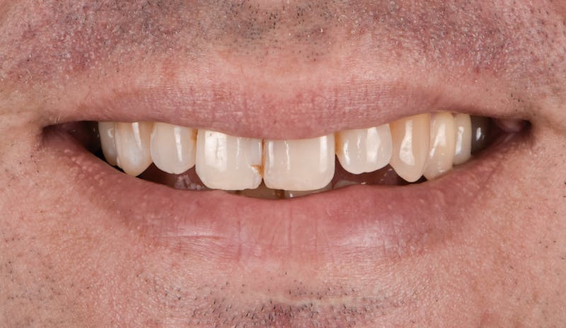 Porcelain Veneers Before & After Gallery - Patient 231504 - Image 1