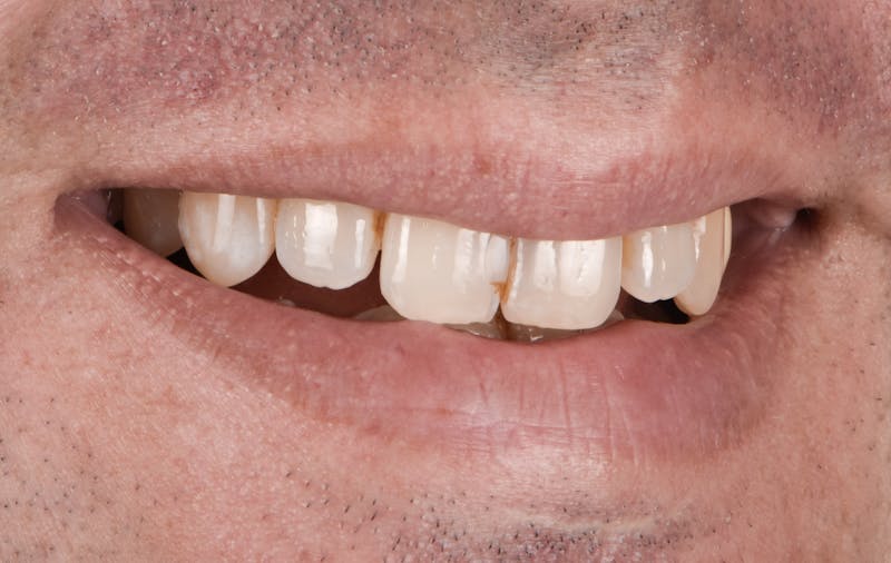 Porcelain Veneers Before & After Gallery - Patient 231504 - Image 3