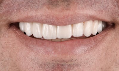 Porcelain Veneers Before & After Gallery - Patient 231504 - Image 2