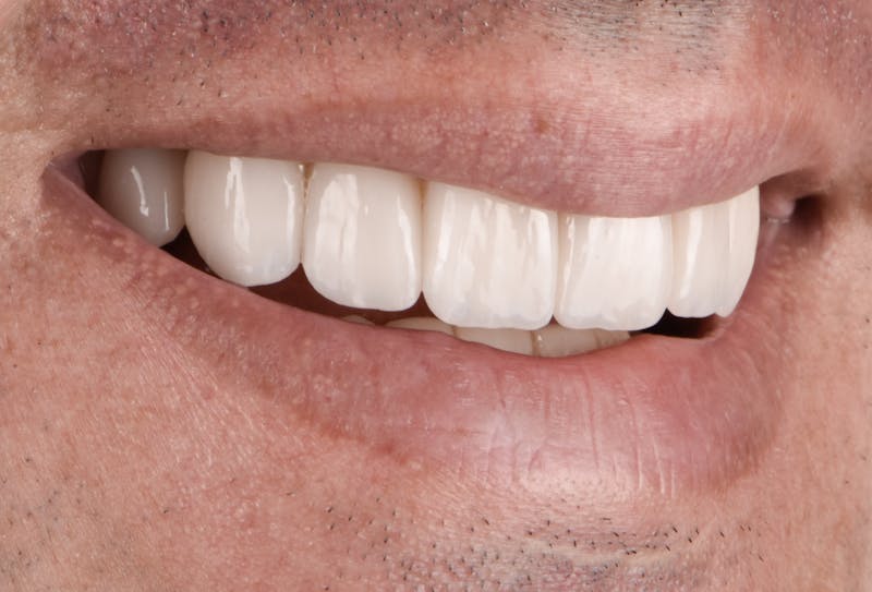 Porcelain Veneers Before & After Gallery - Patient 231504 - Image 4