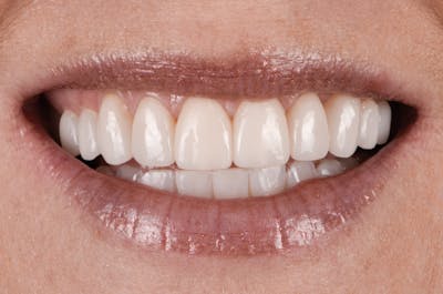 Prep-less Veneers Before & After Gallery - Patient 770059 - Image 2