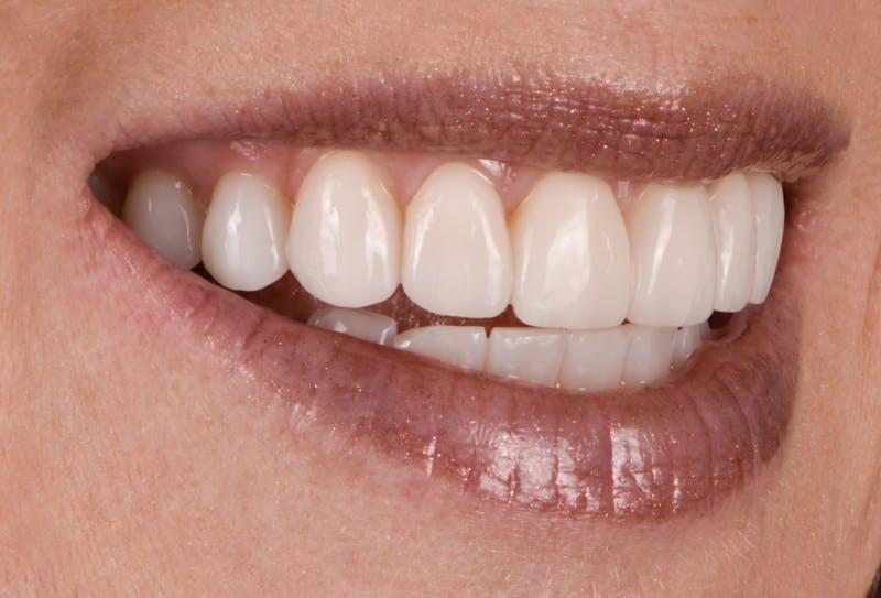 Prep-less Veneers Before & After Gallery - Patient 770059 - Image 4