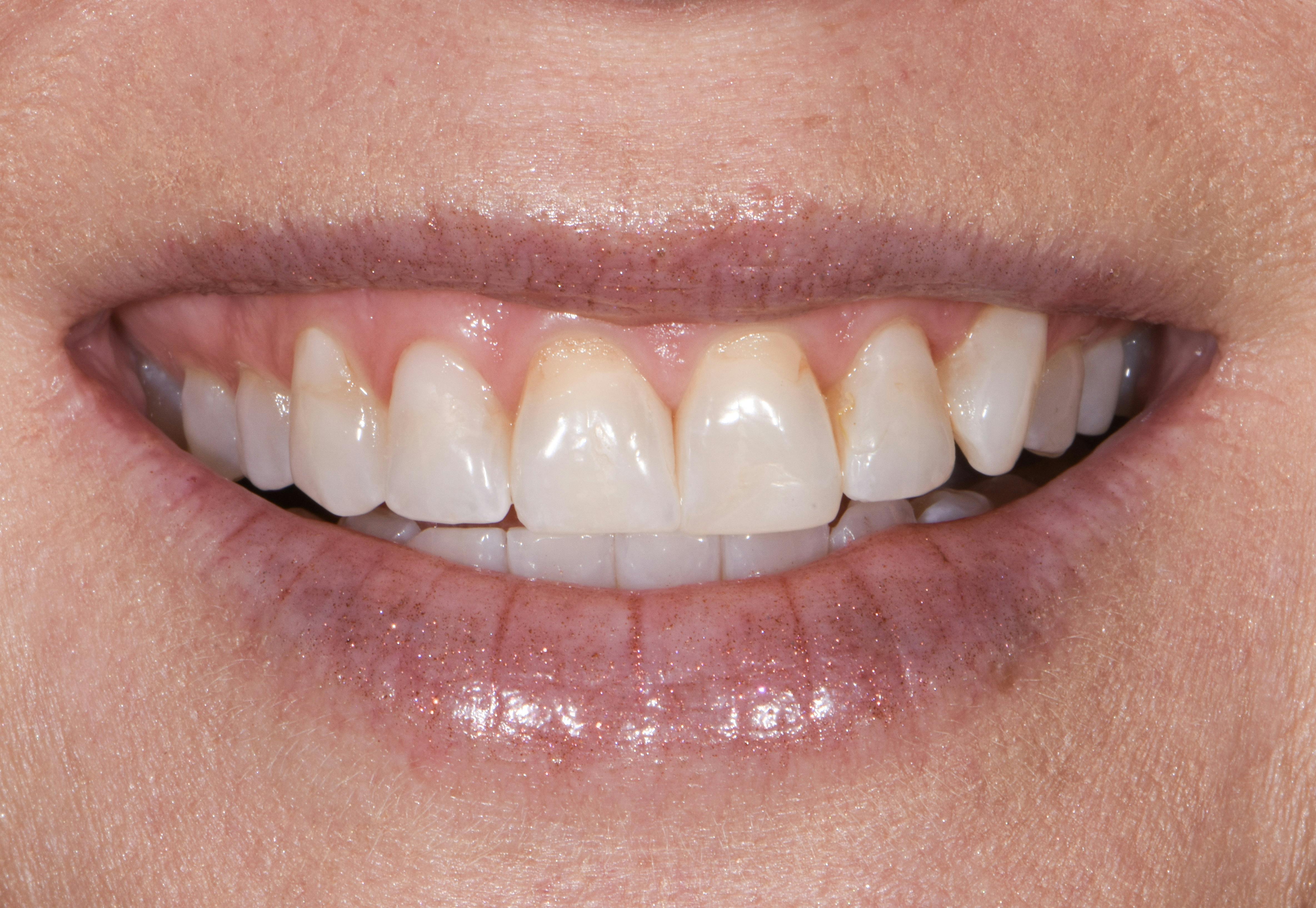 Before & After Photos | Charleston Center for Cosmetic and Restorative Dentistry - Prep-less Veneers - Patient 2 - Before Procedure