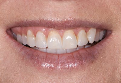 Prep-less Veneers Before & After Gallery - Patient 770059 - Image 1