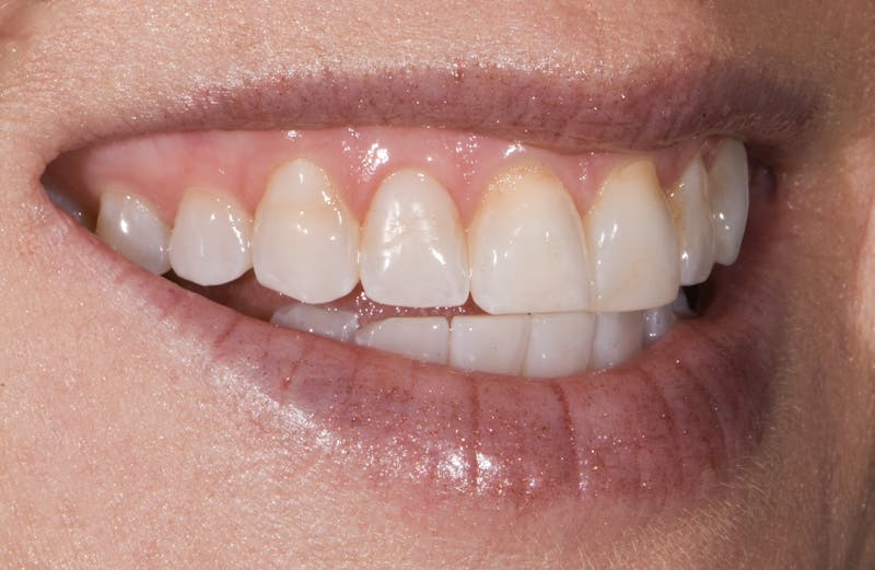 Prep-less Veneers Before & After Gallery - Patient 770059 - Image 3
