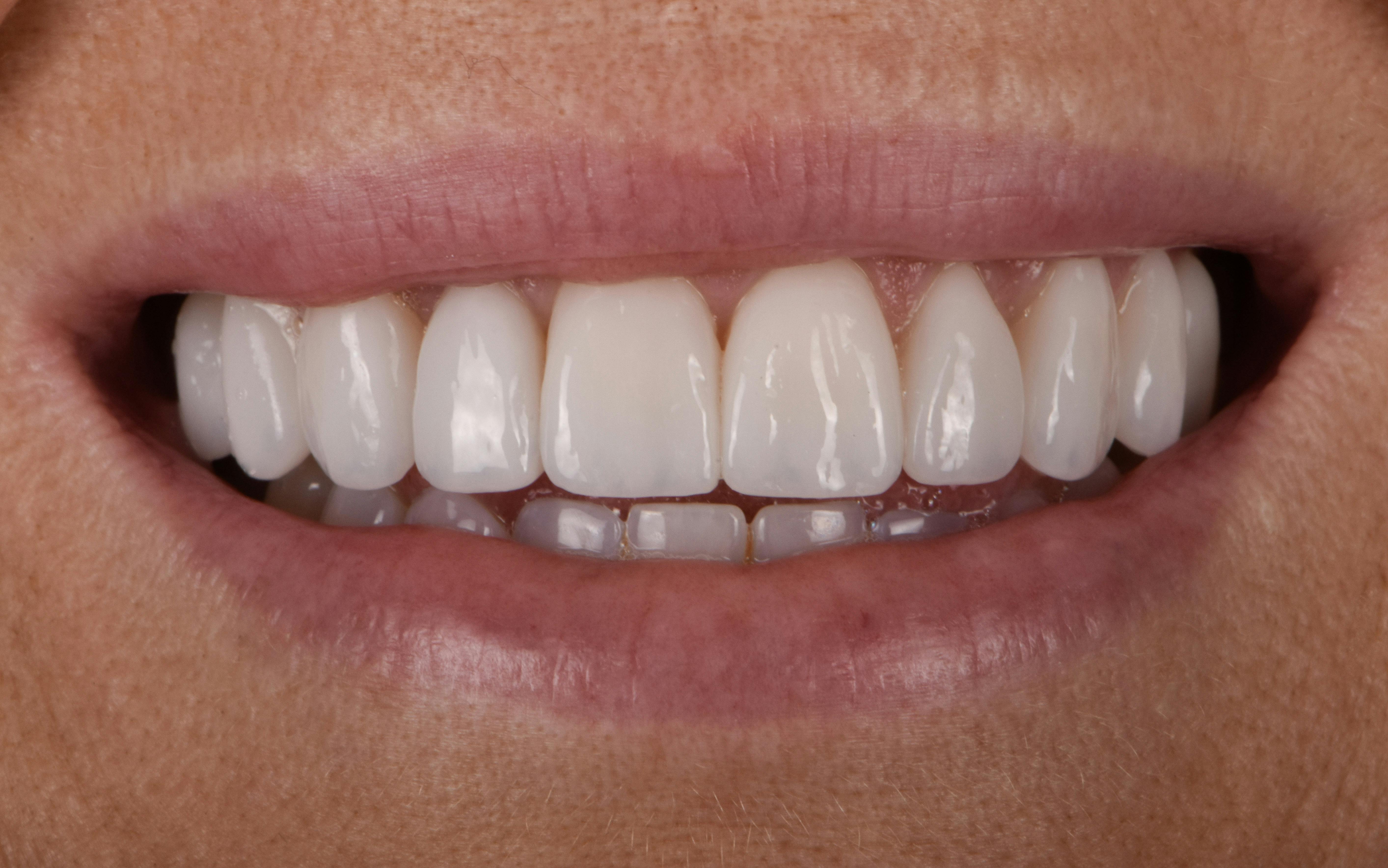 Before & After Photos | Charleston Center for Cosmetic and Restorative Dentistry - Prep-less Veneers - Patient 1 - After Procedure