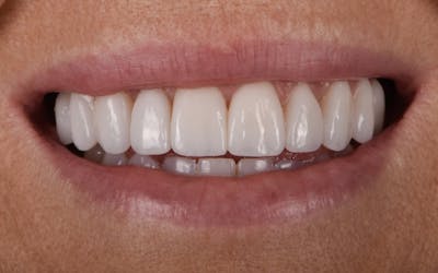 Prep-less Veneers Before & After Gallery - Patient 122114 - Image 2