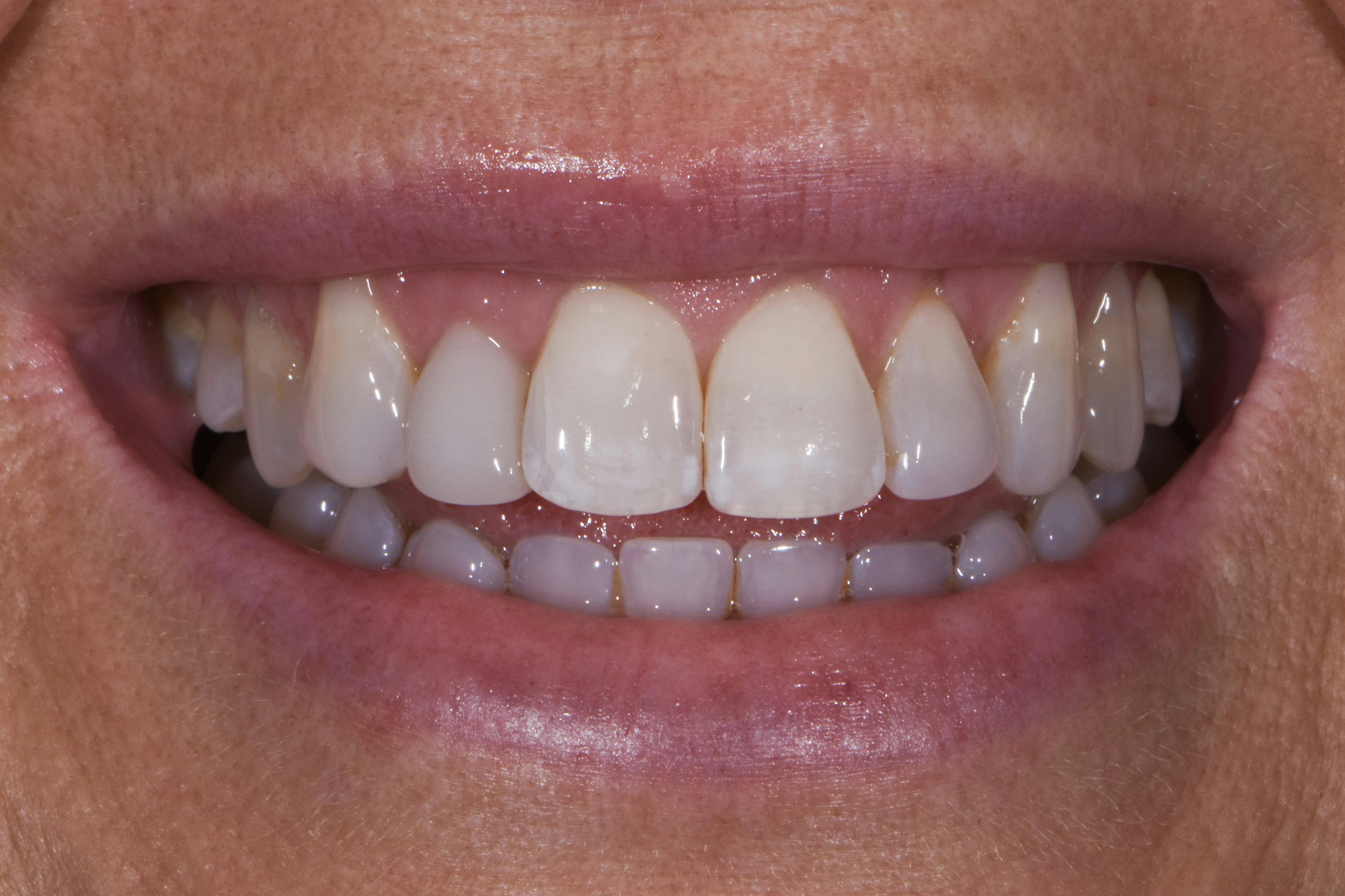 Before & After Photos | Charleston Center for Cosmetic and Restorative Dentistry - Prep-less Veneers - Patient 1 - Before Procedure