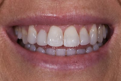 Prep-less Veneers Before & After Gallery - Patient 122114 - Image 1