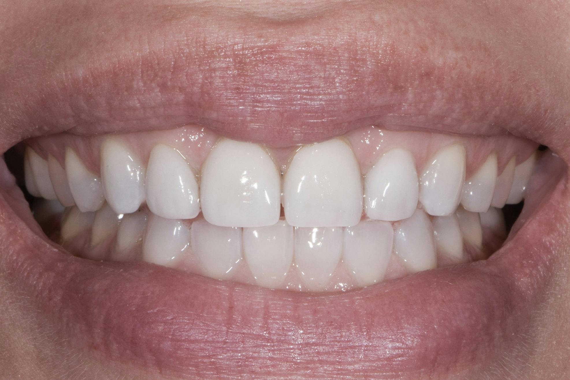 Before & After Photos | Charleston Center for Cosmetic and Restorative Dentistry - Porcelain Crowns - Patient 3 - Before Procedure