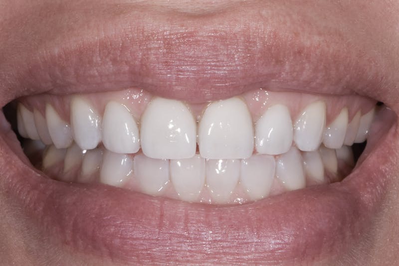 Porcelain Crowns Before & After Gallery - Patient 371988 - Image 1