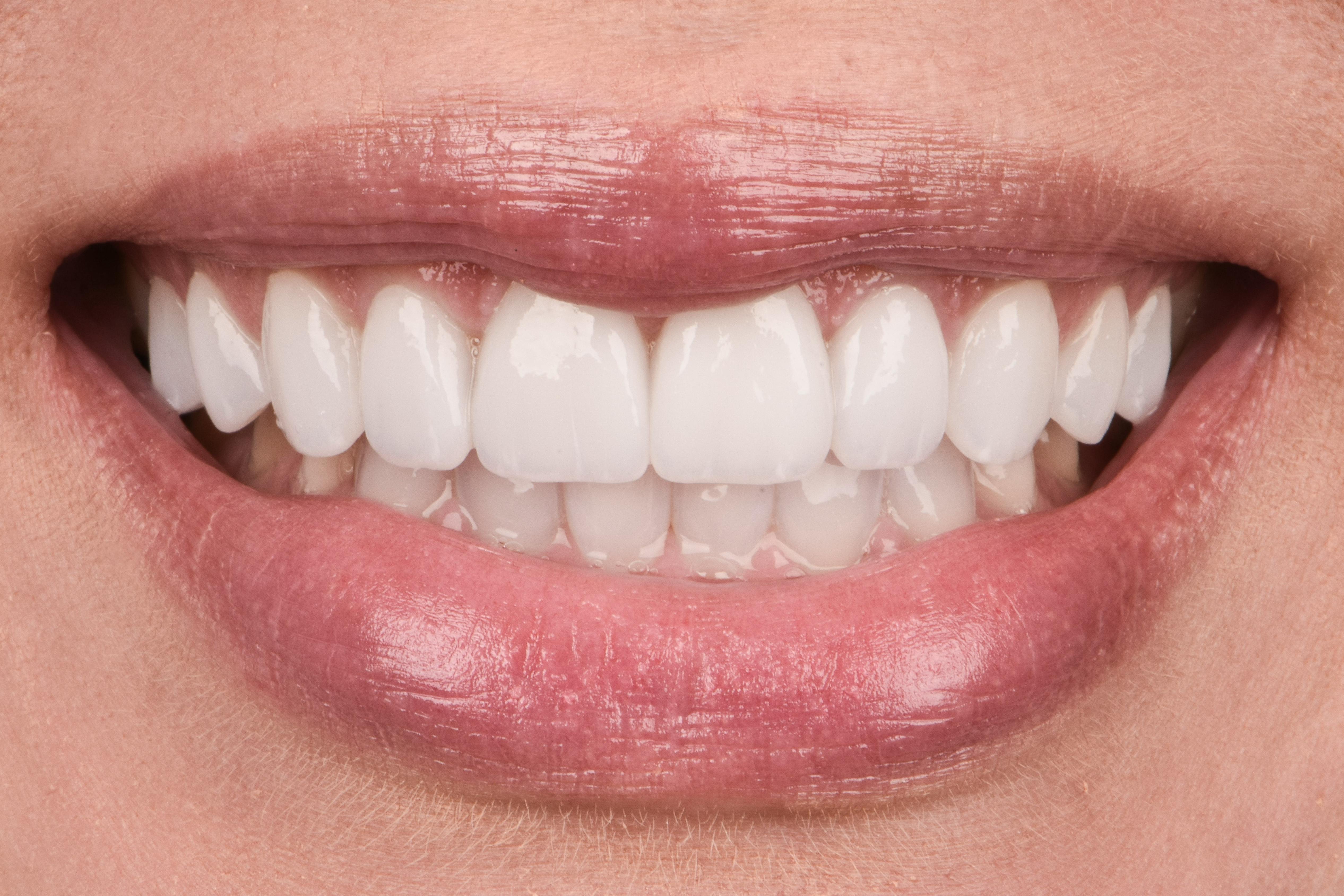 Before & After Photos | Charleston Center for Cosmetic and Restorative Dentistry - Porcelain Crowns - Patient 3 - After Procedure