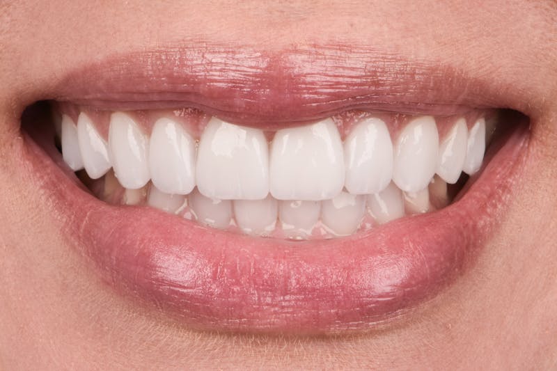 Porcelain Crowns Before & After Gallery - Patient 371988 - Image 2