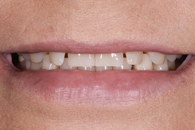 Porcelain Crowns Before & After Gallery - Patient 163543 - Image 1