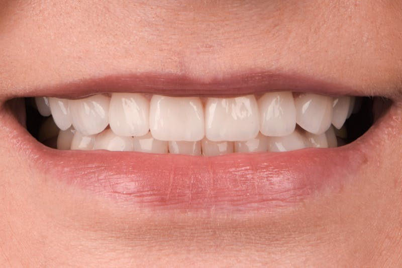 Porcelain Crowns Before & After Gallery - Patient 163543 - Image 2