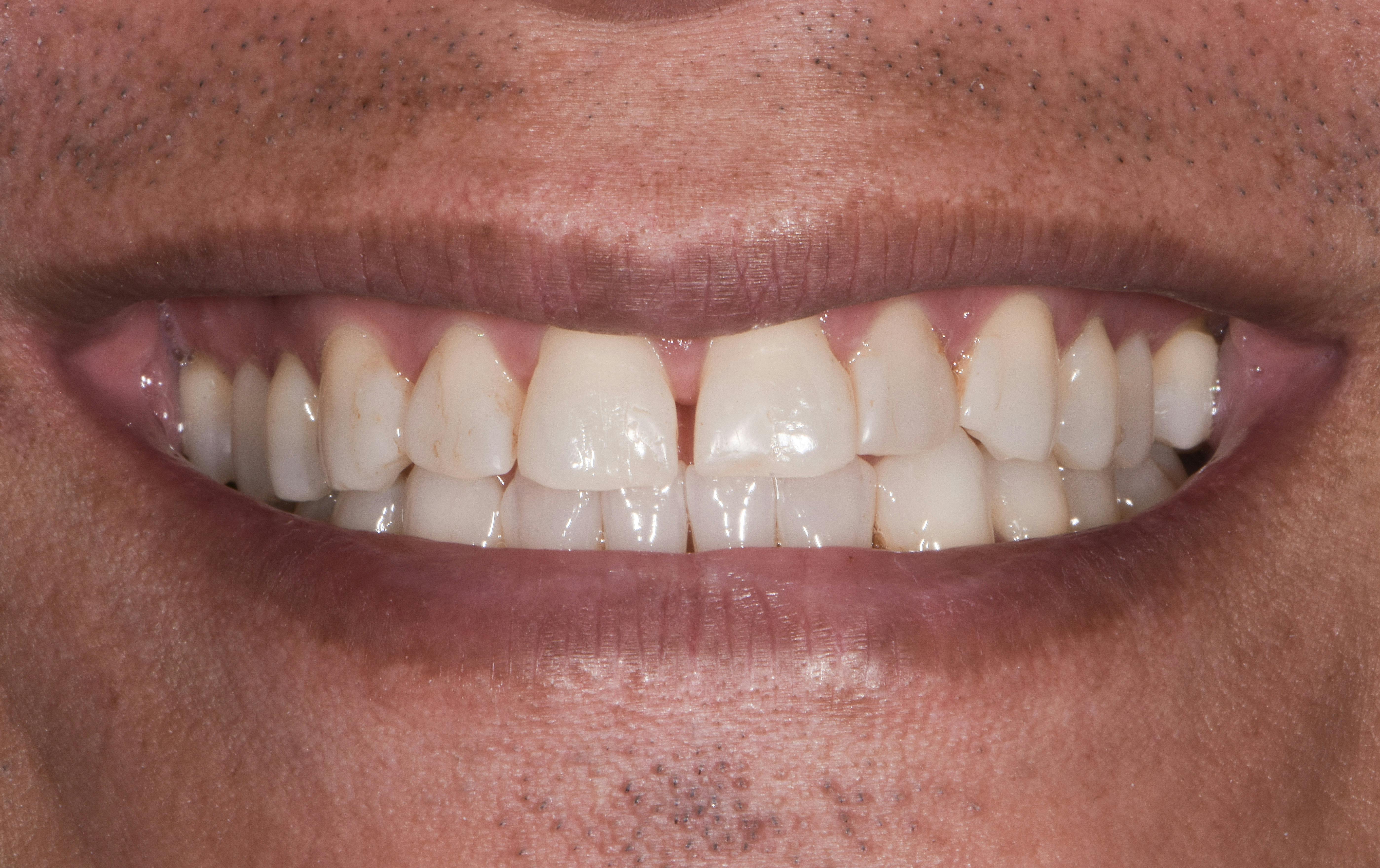 Before & After Photos | Charleston Center for Cosmetic and Restorative Dentistry - Porcelain Crowns - Patient 1 - Before Procedure
