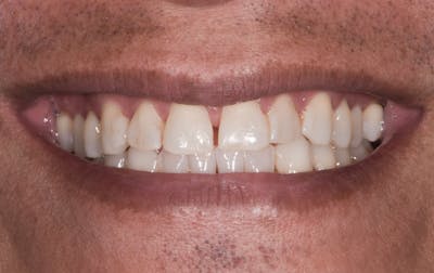 Porcelain Crowns Before & After Gallery - Patient 464362 - Image 1