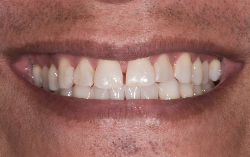 Porcelain Crowns Before & After Gallery - Patient 464362 - Image 1
