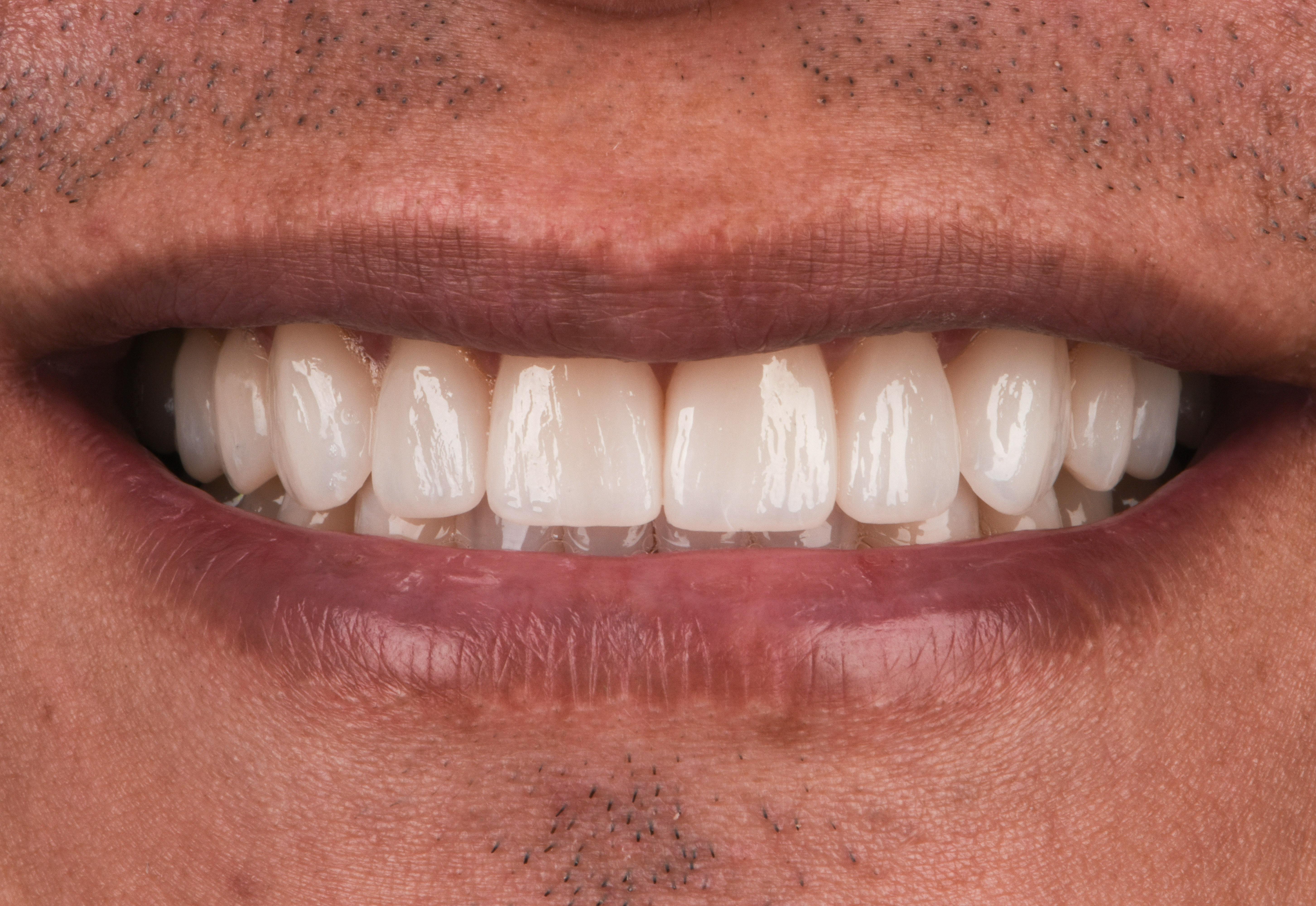 Before & After Photos | Charleston Center for Cosmetic and Restorative Dentistry - Porcelain Crowns - Patient 1 - After Procedure