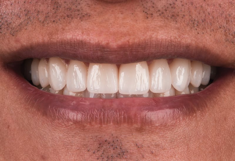 Porcelain Crowns Before & After Gallery - Patient 464362 - Image 2