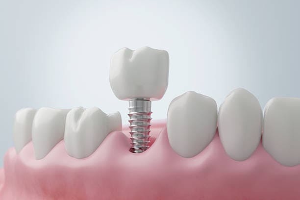 dental implant graphic