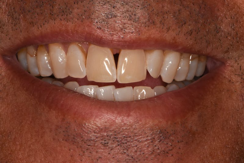 Teeth Whitening Before & After Gallery - Patient 330352 - Image 1