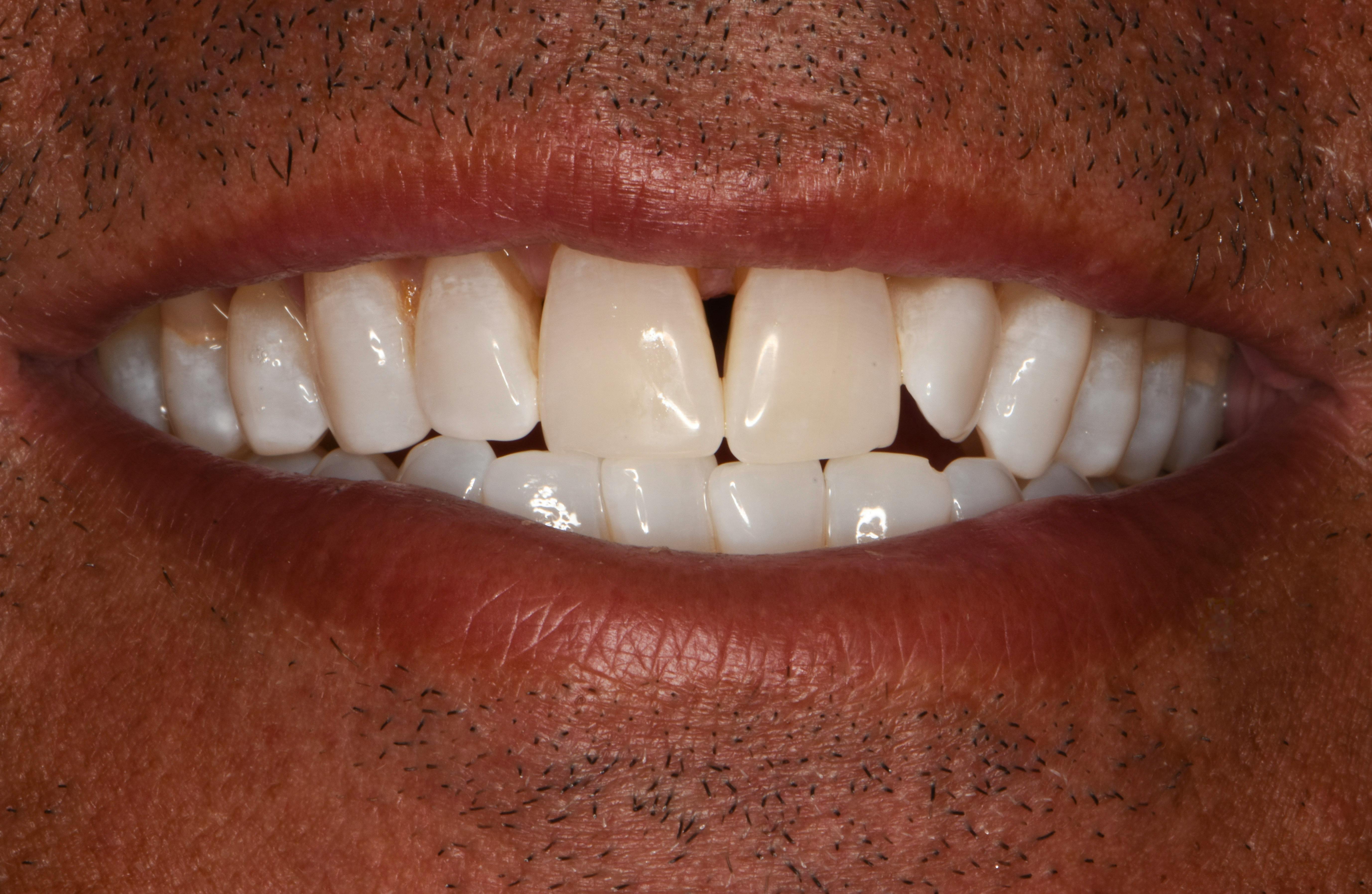 Before & After Photos | Charleston Center for Cosmetic and Restorative Dentistry - Teeth Whitening - Patient 1 - After Procedure